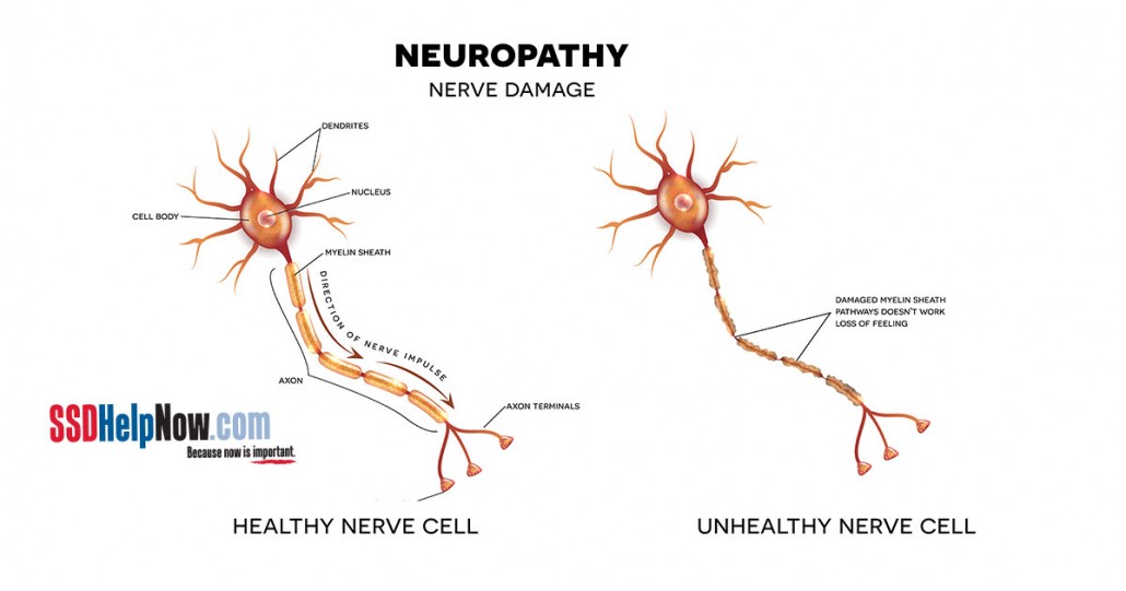 Neuropathy and falling in elderly